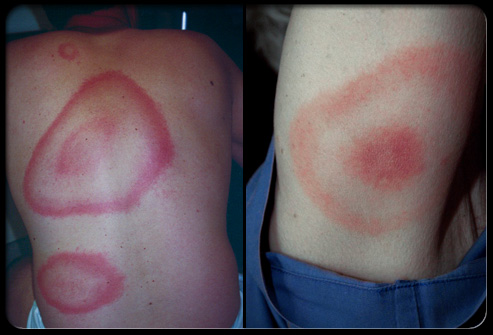 bullseye rash associated with Lyme Disease
