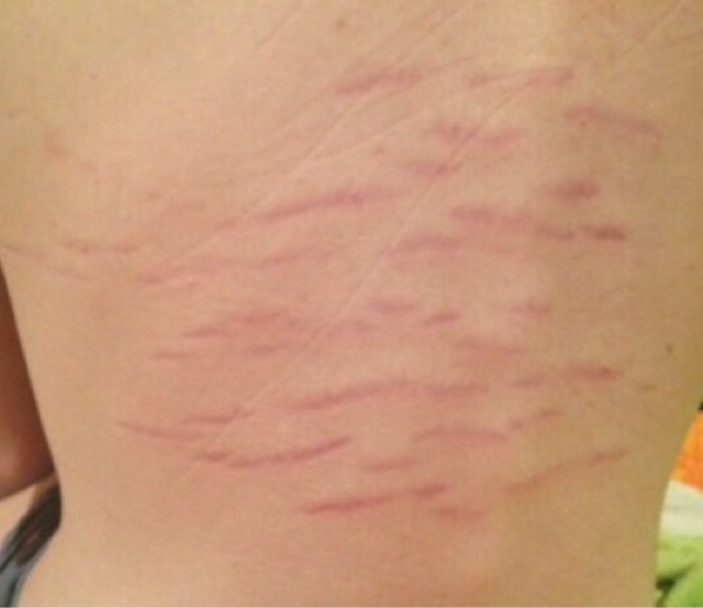 Know Your Rash – Wayne County Lyme Disease Task Force